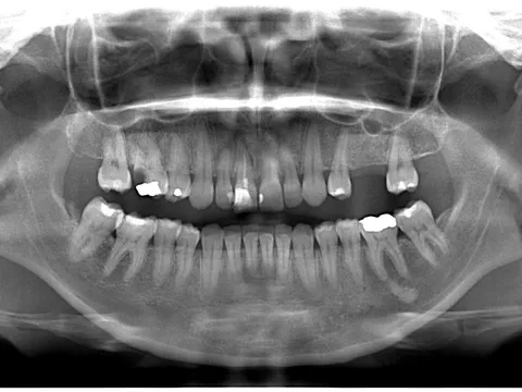 Ejemplo de radiografías extraorales