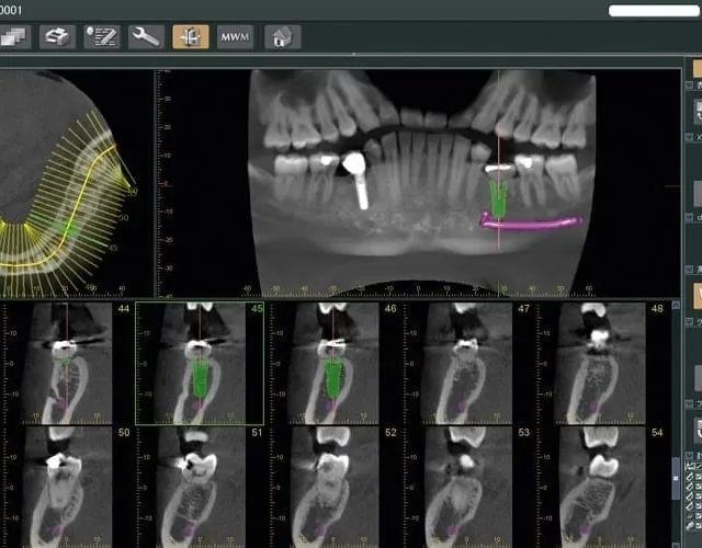 Ejemplo real de tomografía 3d (cbct) tomada en El Radiológico Oral