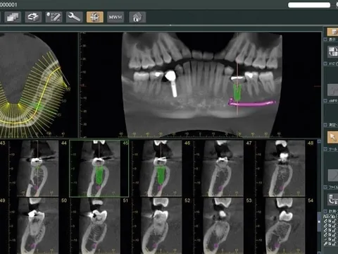 Ejemplo de tomografía 3d (cbct)